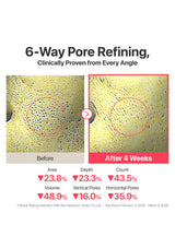 Before and after comparison of pore refining treatment with clinical data on a white background.
