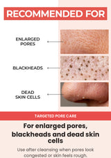 Examples of enlarged-looking pores, blackheads and visible dead skin cells