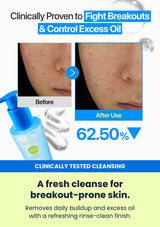 Numbuzin No.0 cleansing jelly before-and-after cleansing comparison for breakout-prone skin