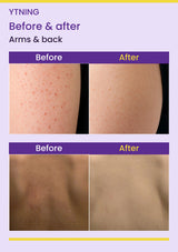 YTNING Scaling Toning Scrub Wash before-and-after arms & back photographs with readable English labels